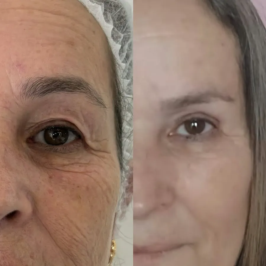Olhar de paciente antes e oito meses depois