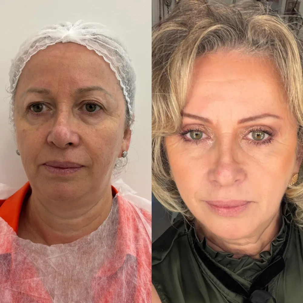 Rosto de paciente antes e depois