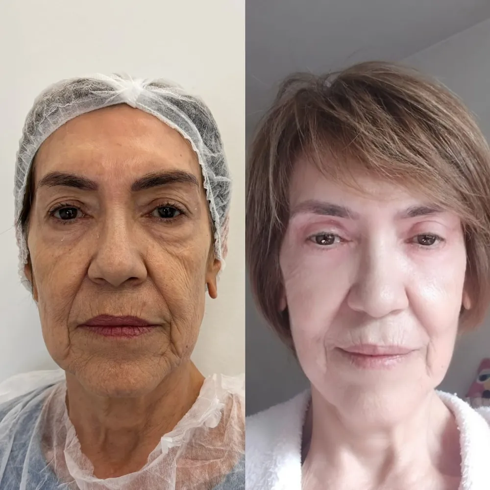 Rosto de paciente antes e depois do rejuvenescimento facial